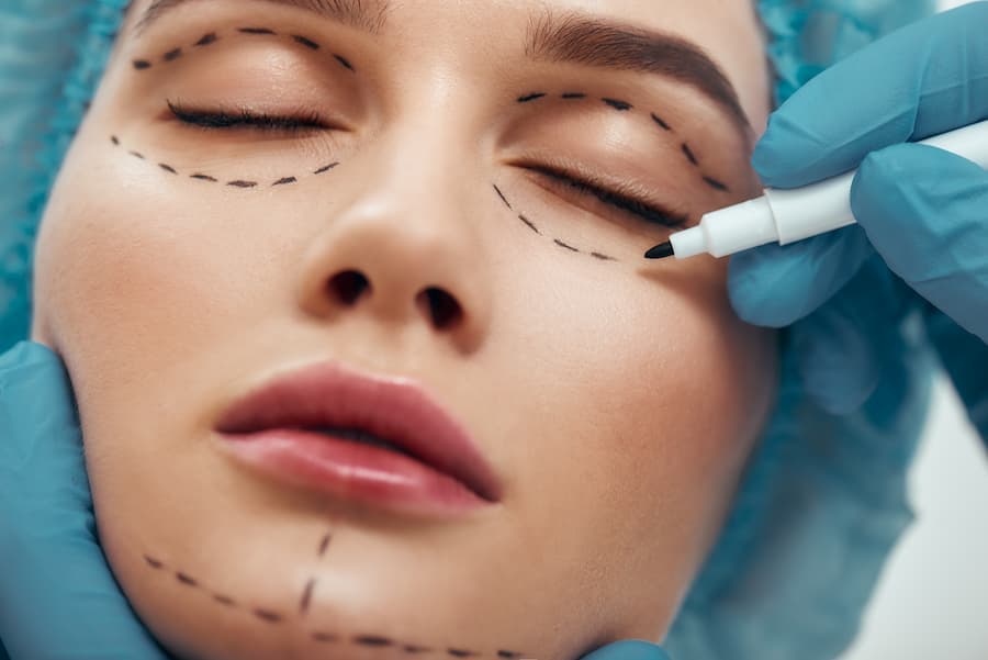 Rosto de mulher sendo marcado com caneta para procedimento estético