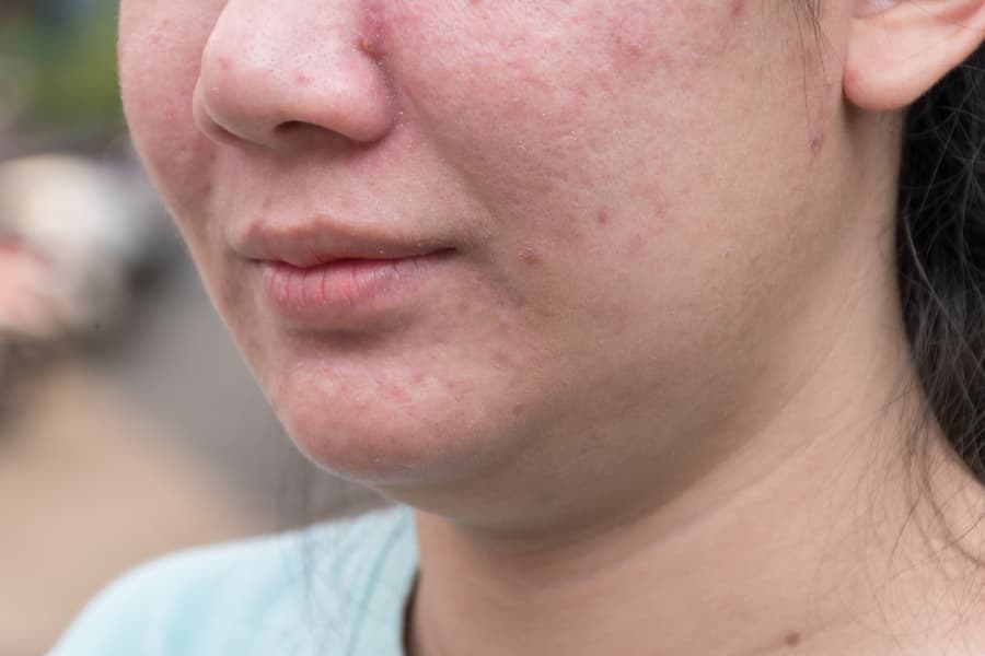 detalhe de rosto de mulher com espinhas